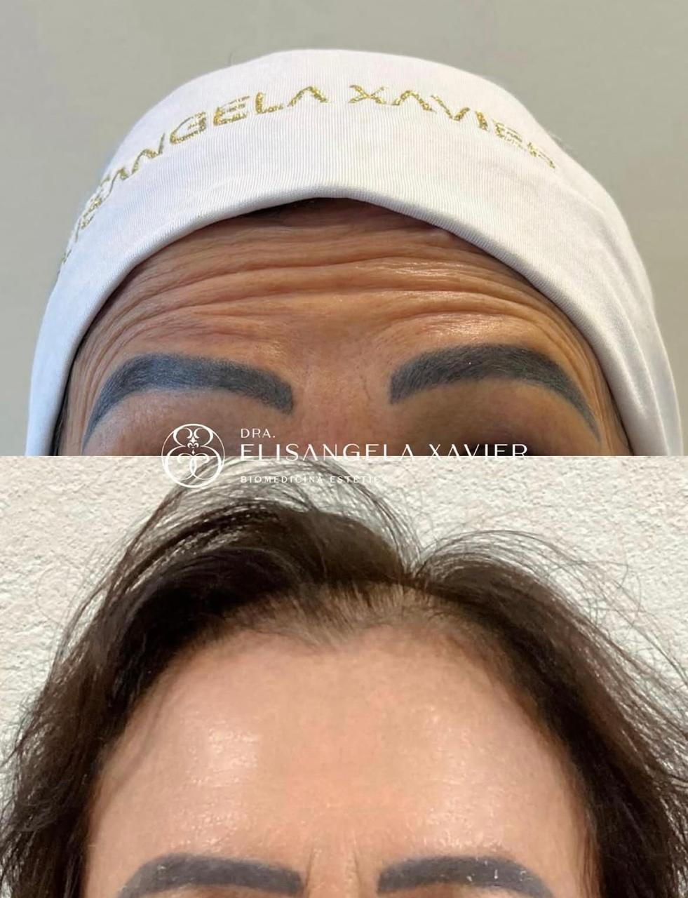 Registro antes e depois de tratamento estético