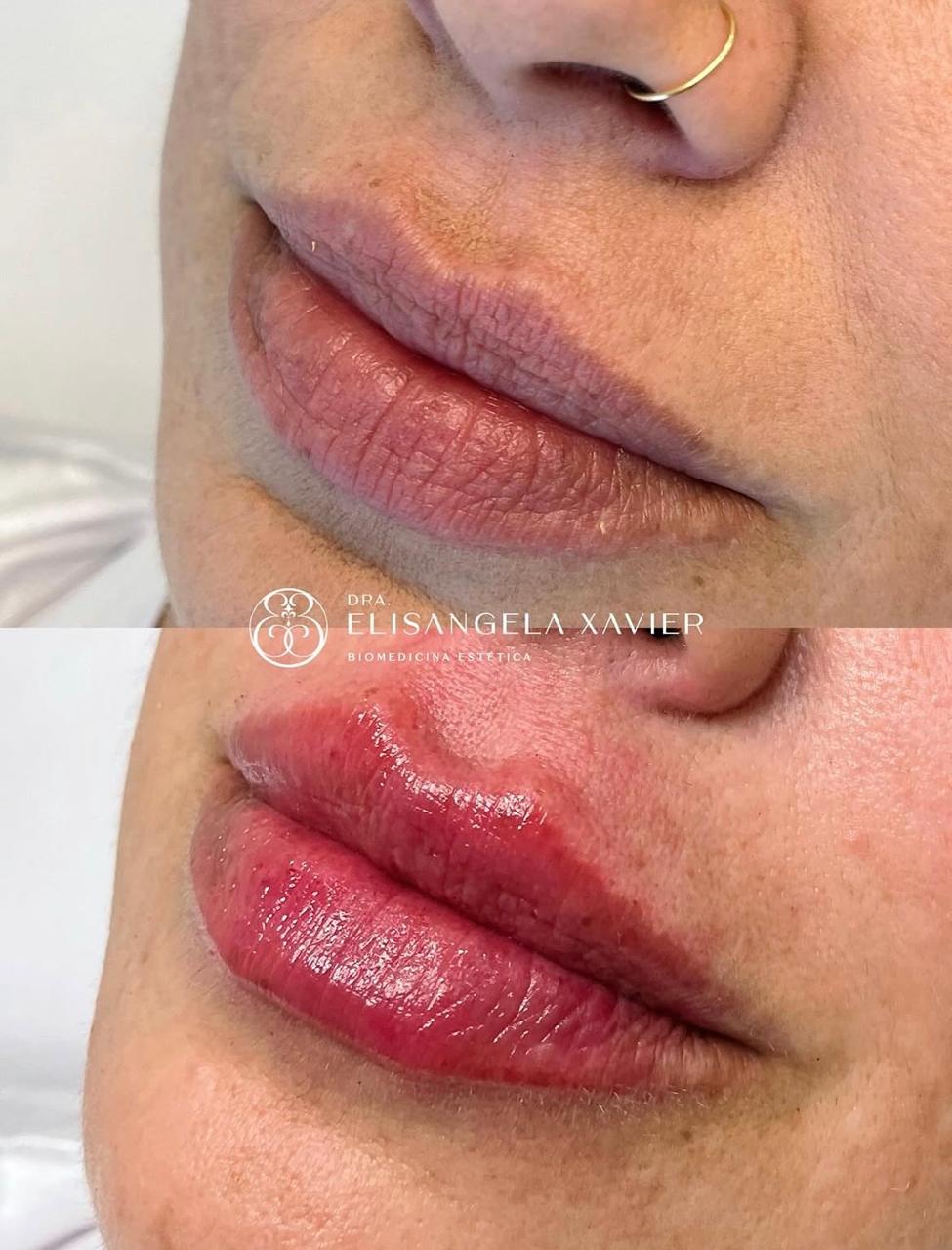 Registro antes e depois de tratamento estético