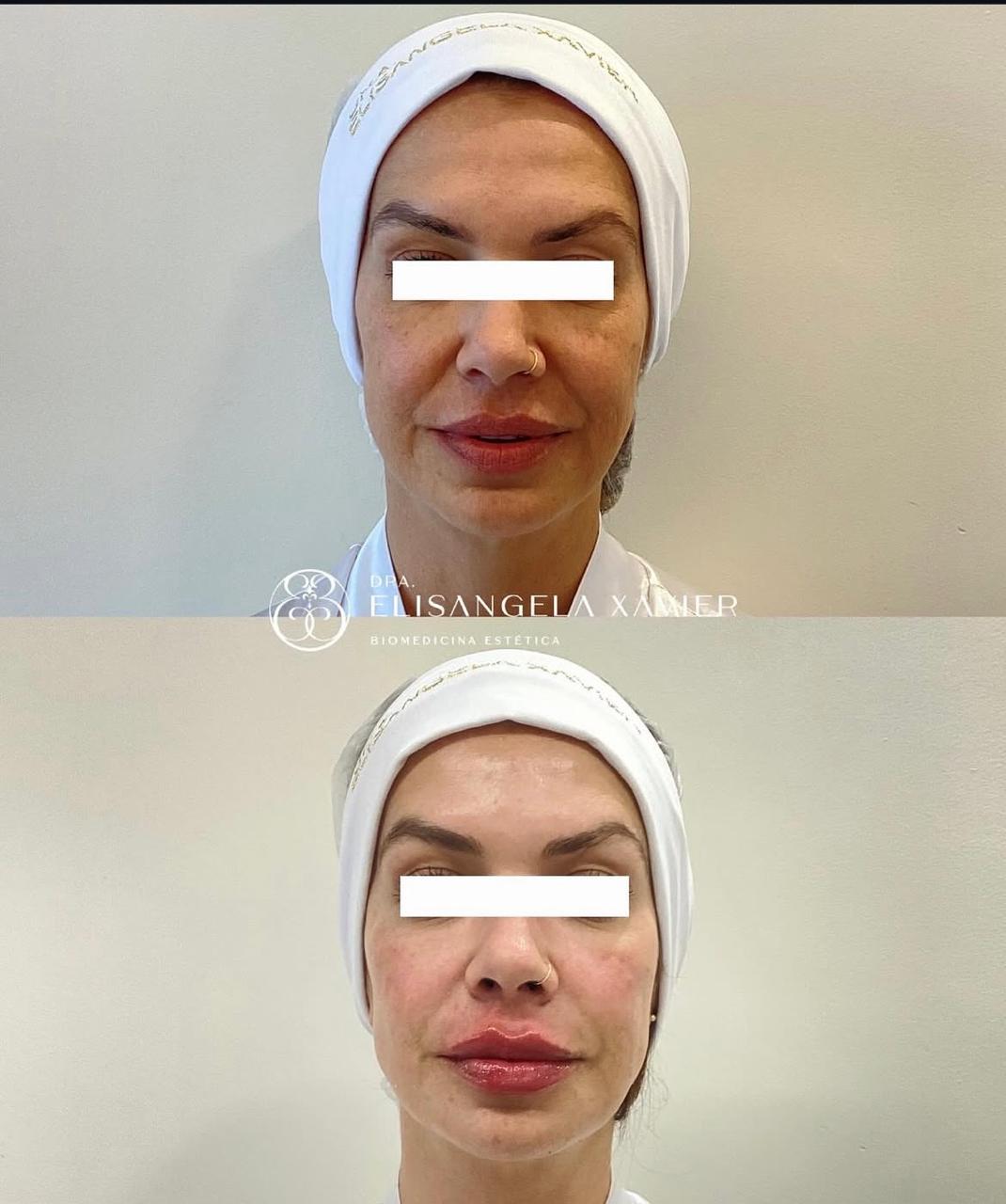 Registro antes e depois de tratamento estético